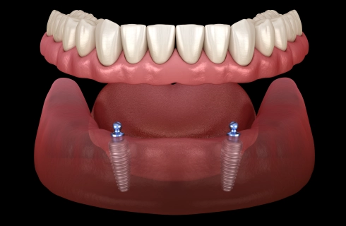 klikprothese 2 implantaten met locators