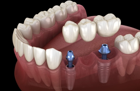 meerdere implantaten
