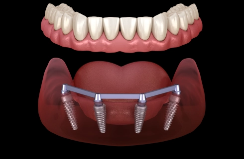 Klikprothese 4 implantaten met bar